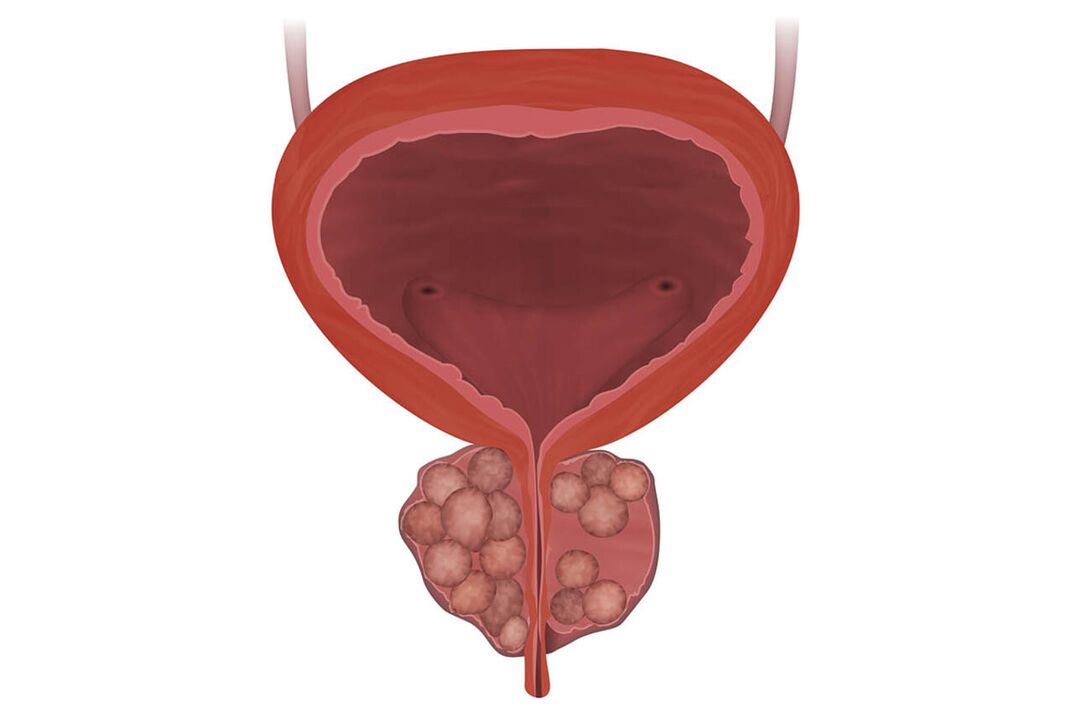 Síntomas de prostatite